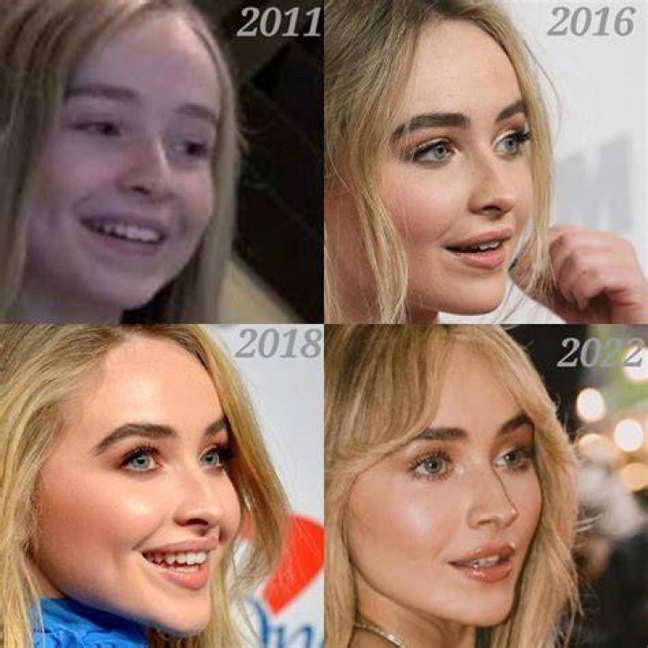 Analyzing Sabrina Carpenter's Lip Filler Rumors: Truth Or Fiction?