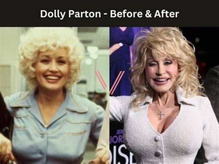 Dolly Parton Breast Reduction Before and After Pictures